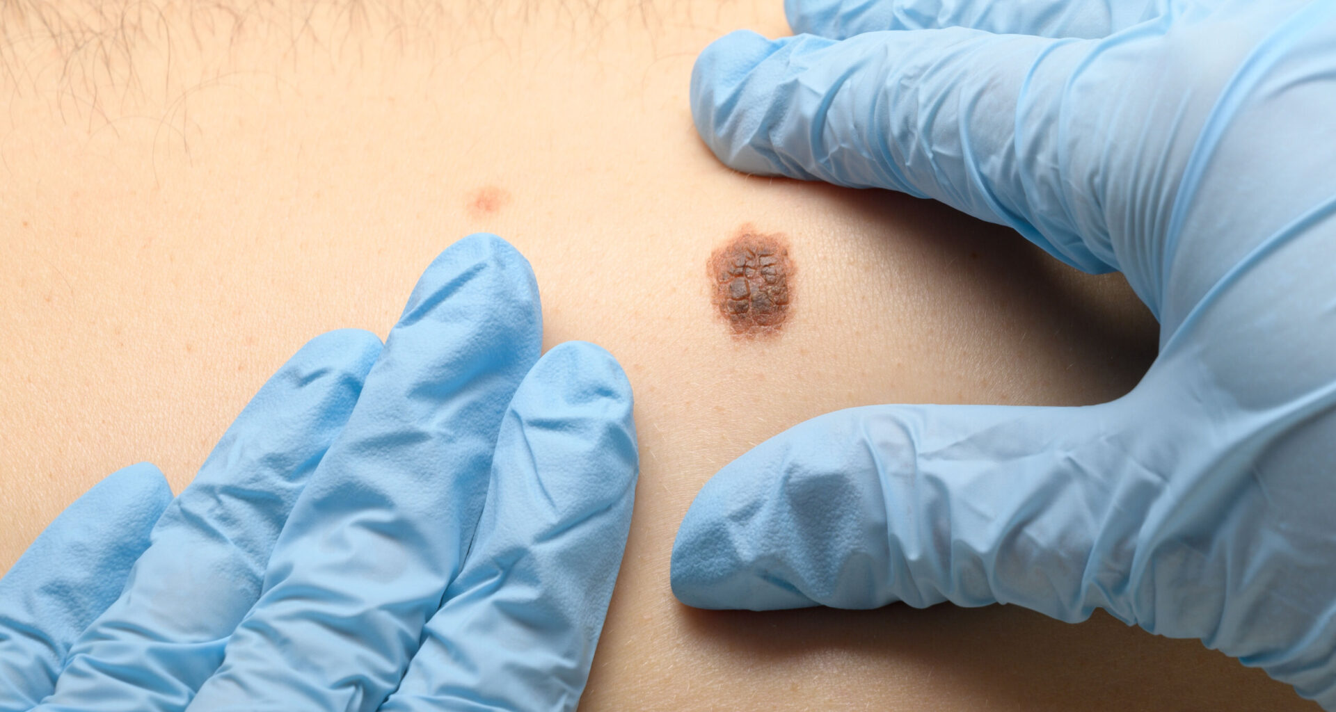 Love the skin you’re in? Check it for signs of cancer