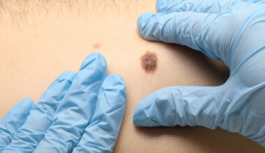 Love the skin you’re in? Check it for signs of cancer