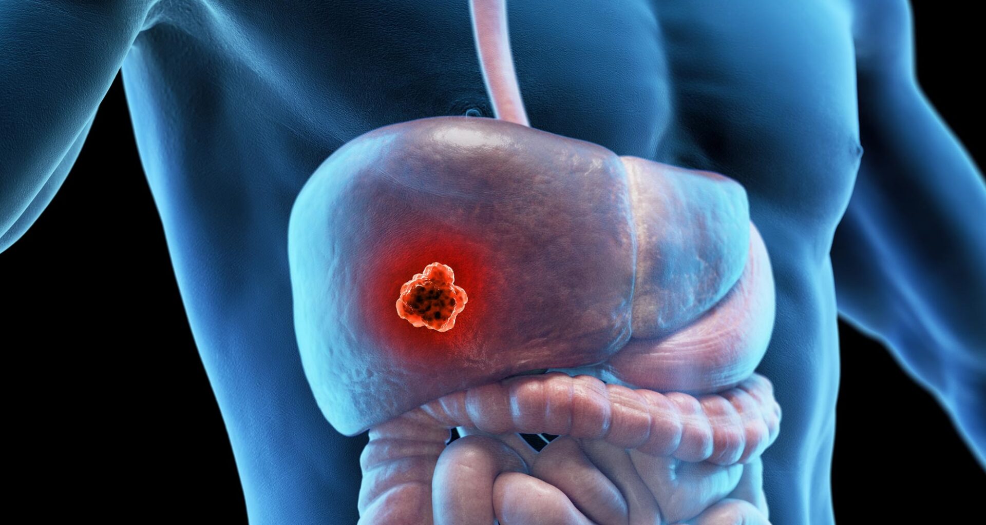 Liver Cancer Male Anatomy