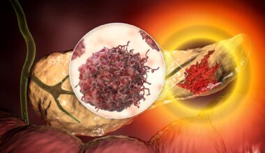 Pancreatic Cancer Malignant Tumor Cell Inset