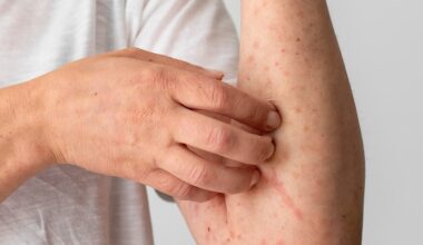 Osage County confirms measles case; exposure reported at a Topeka church