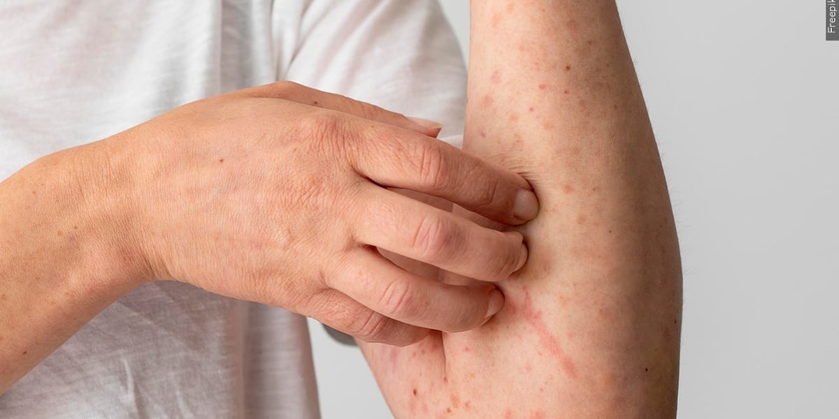 Osage County confirms measles case; exposure reported at a Topeka church