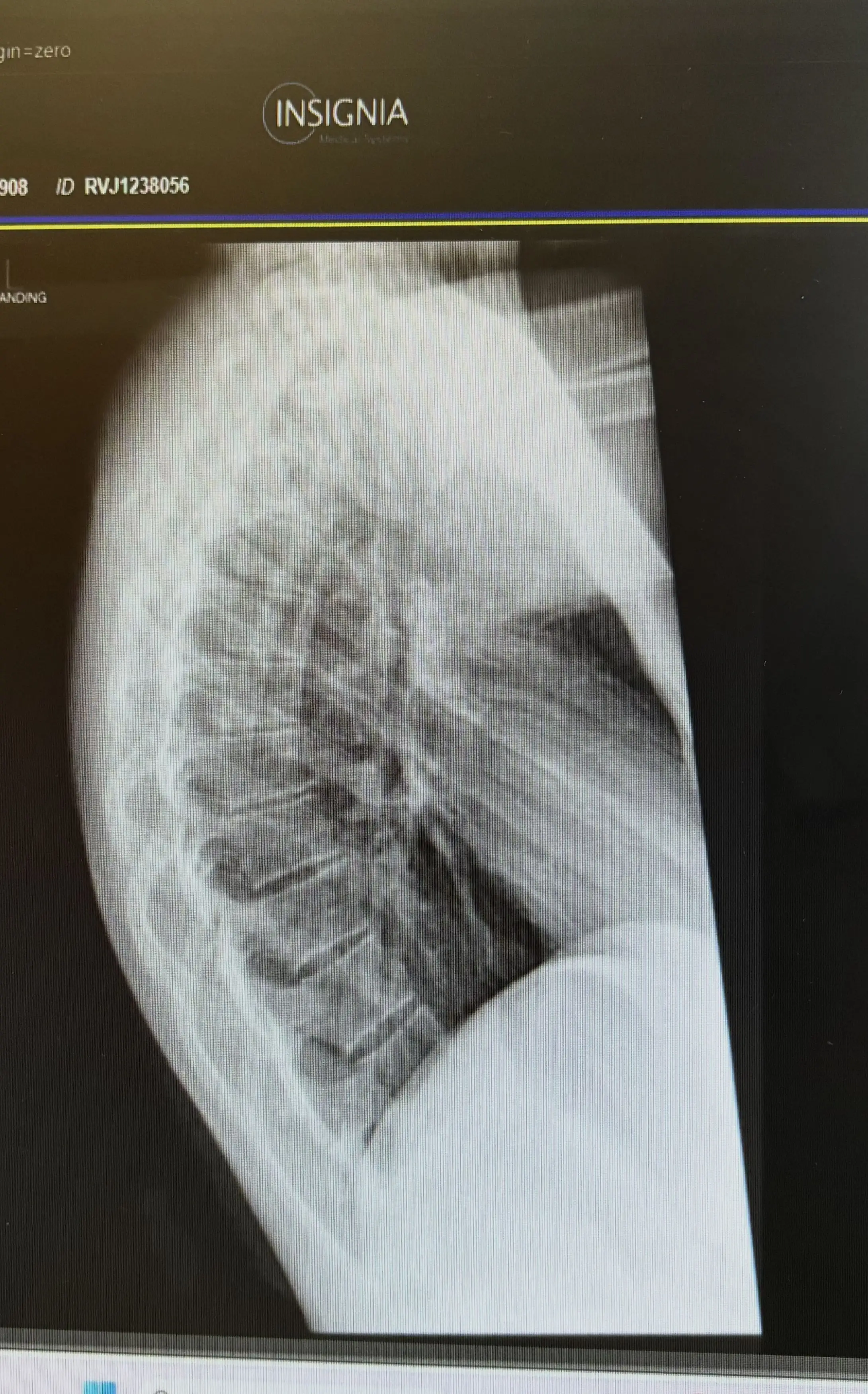 Charlotte says she's been diagnosed with kyphosis, a curvature of the spine (Kennedy News and Media)
