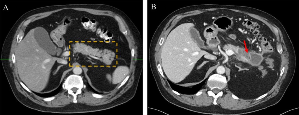 Collage of two axial contrast-enhanced CT scans: (A) A pre-diagnostic scan with the pancreas outlined by yellow dashes. (B) A diagnostic scan 2.4 years later shows a large pancreatic ductal adenocarcinoma indicated by a red arrow.