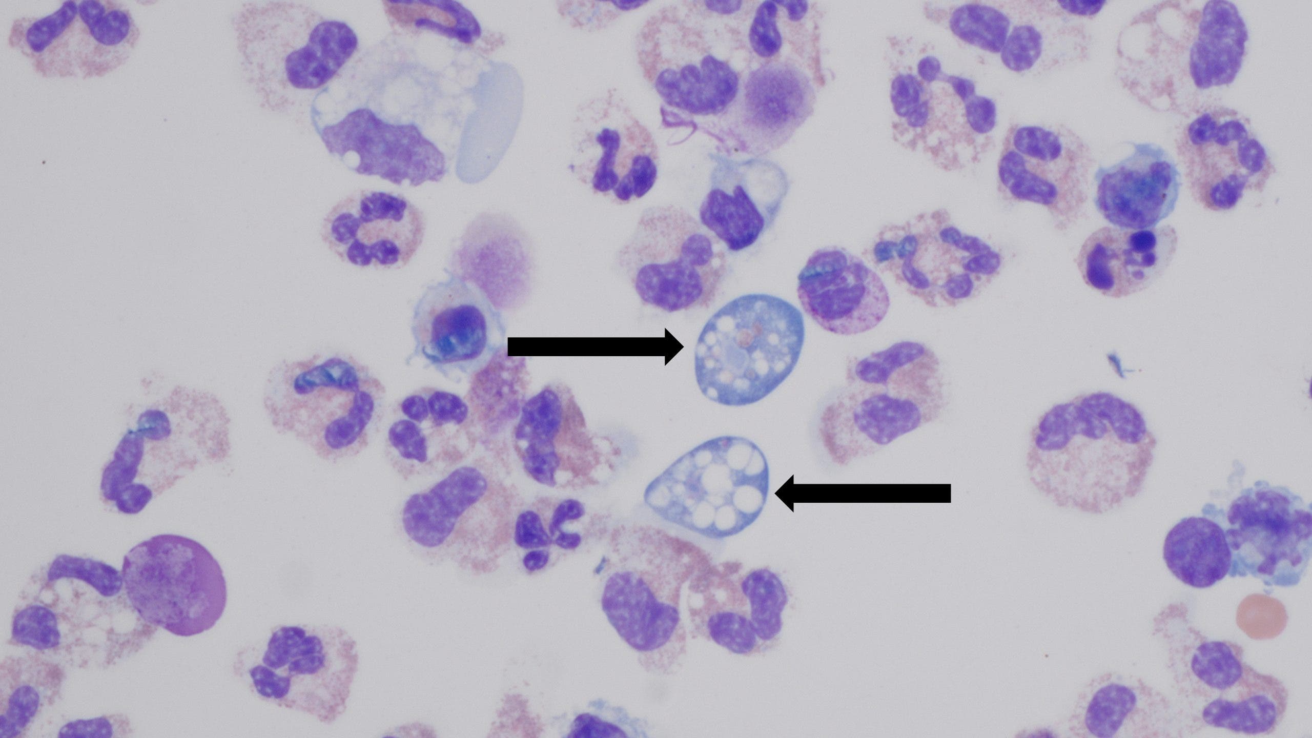 Naegleria fowleri  infects people by traveling up the nose and to the brain (shown here) where it consumes brain tissue