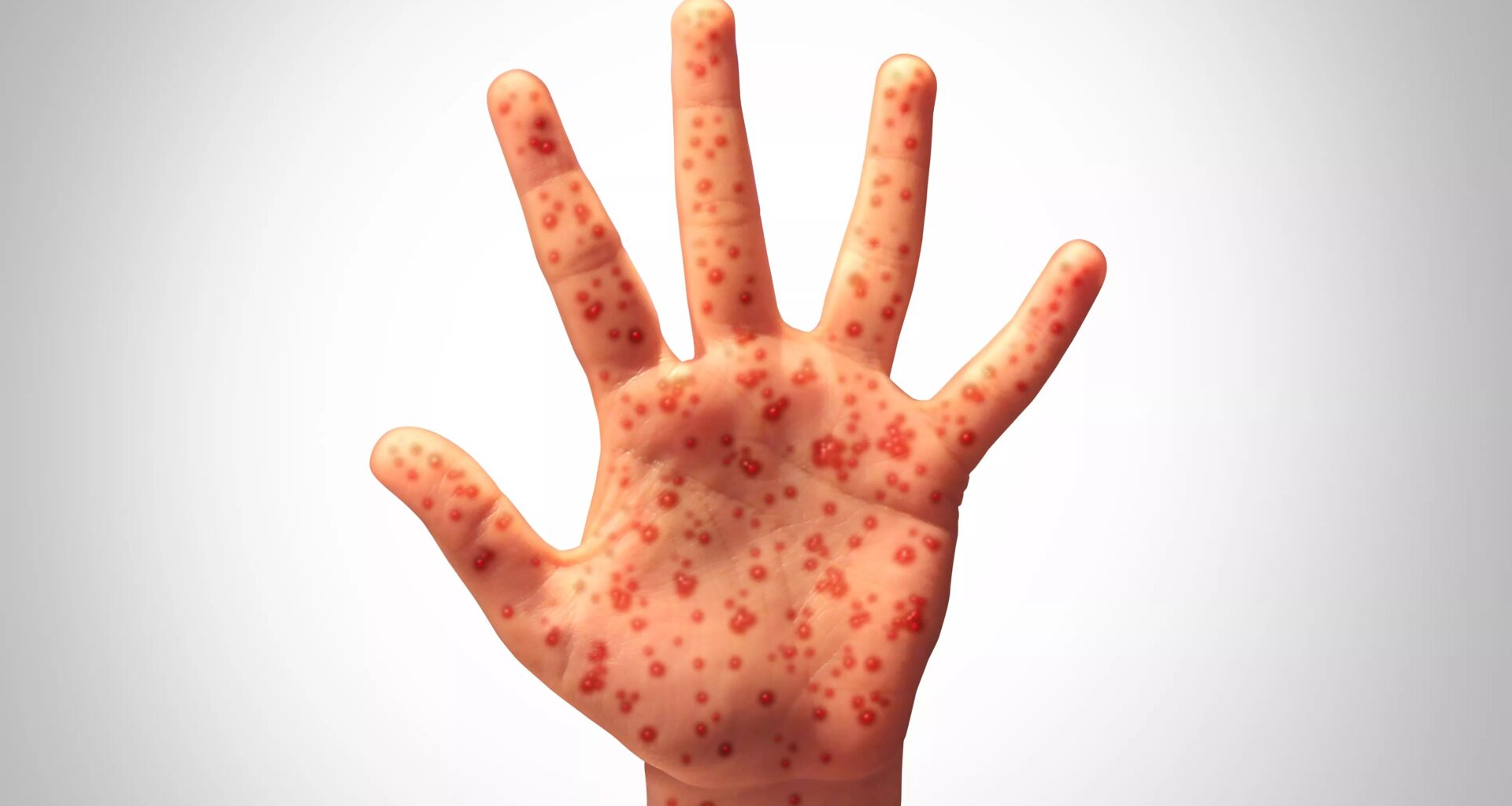 a hand covered in measles marks