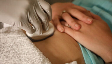 Abortion bans lead to worse outcomes for miscarriages