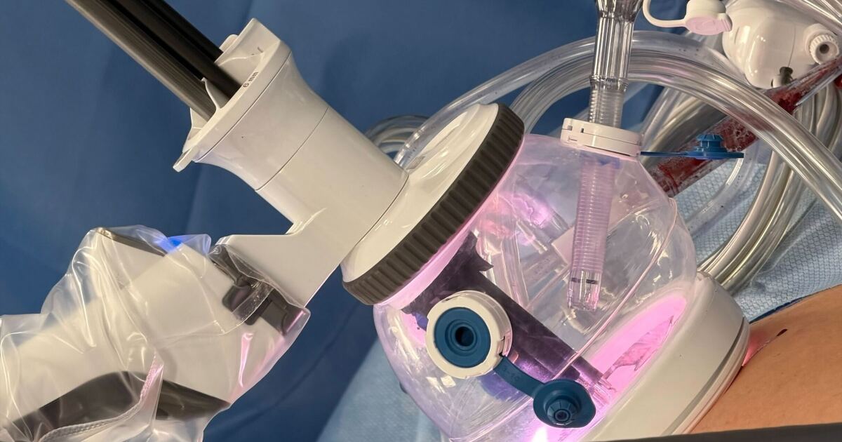 ECU Health has performed a North Carolina first: a new type of colorectal robotic surgery
