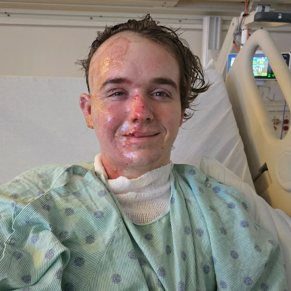The 20-year-old is expected to undergo additional surgeries next week, including a skin graft procedure. GoFundMe