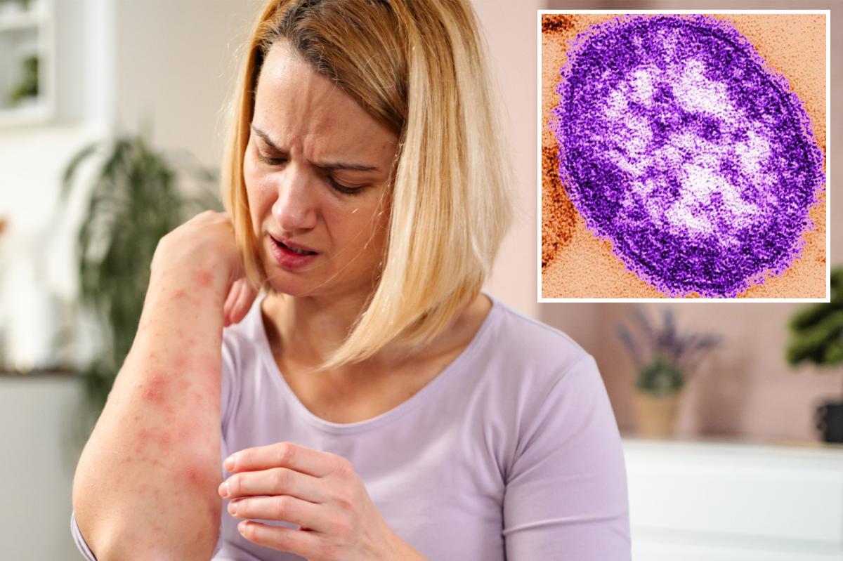 Measles emerges in California wastewater as health experts sound alarm