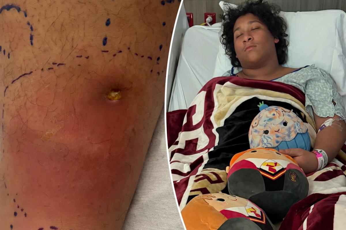 Florida teen 'fighting for his life' from flesh-eating bacteria