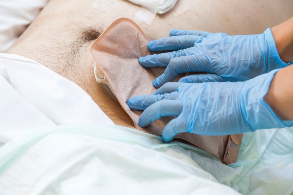 Gloved hands applying a colostomy bag to a patient's abdomen after colon cancer surgery.