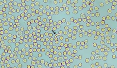 Louisiana Notches a Sickle Cell First