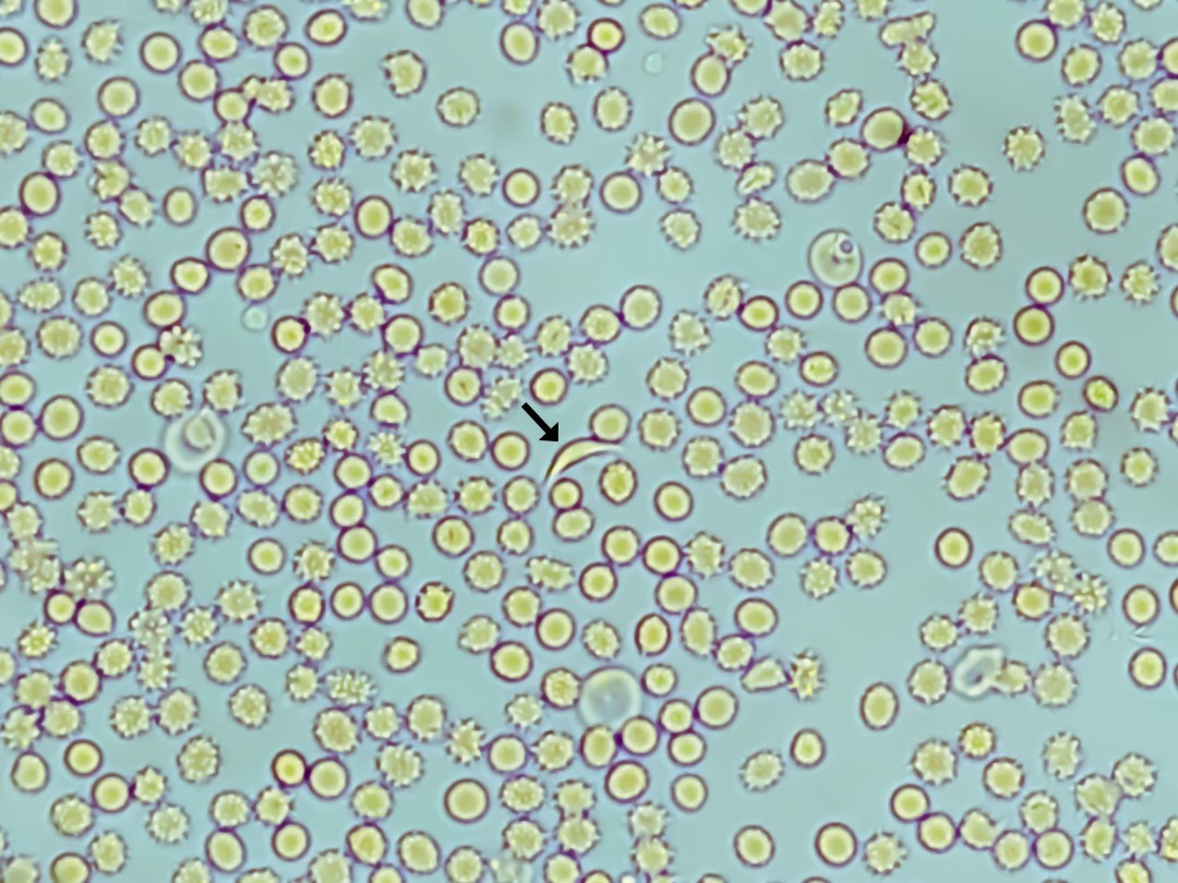 Louisiana Notches a Sickle Cell First