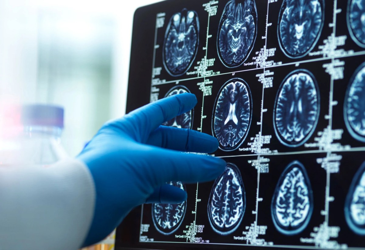 Trial Drug Could Clear Toxic Alzheimer’s Proteins and Restore Memory