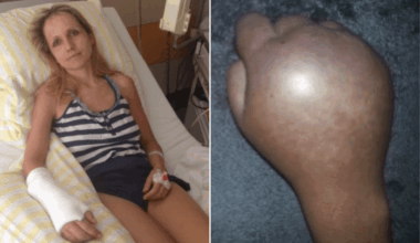 Woman Went for Routine Surgery, Ended up Losing Her Arm–Worse Was to Come
