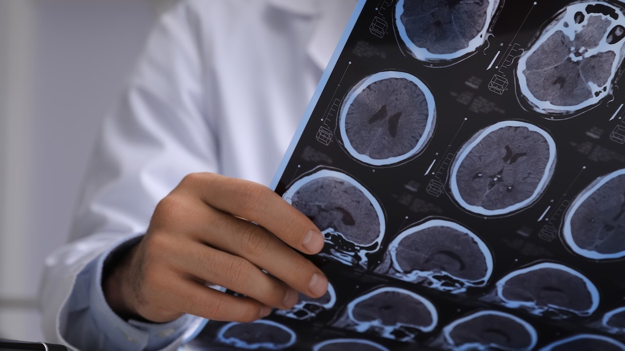 Brain cancer misdiagnosis turns out to be pork tapeworm infection