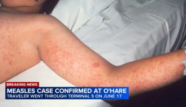 Person who traveled through Chicago O'Hare Airport tests positive for measles; symptoms include rash, fever, cough, runny nose