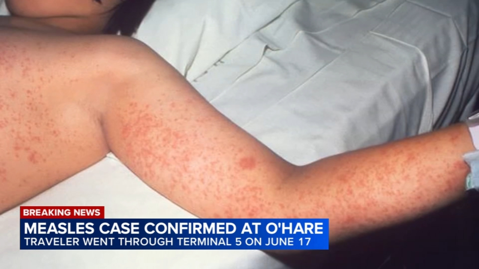 Person who traveled through Chicago O'Hare Airport tests positive for measles; symptoms include rash, fever, cough, runny nose