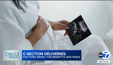C-section rates in US remain high as experts weigh risks and benefits