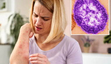 Measles emerges in California wastewater as health experts sound alarm