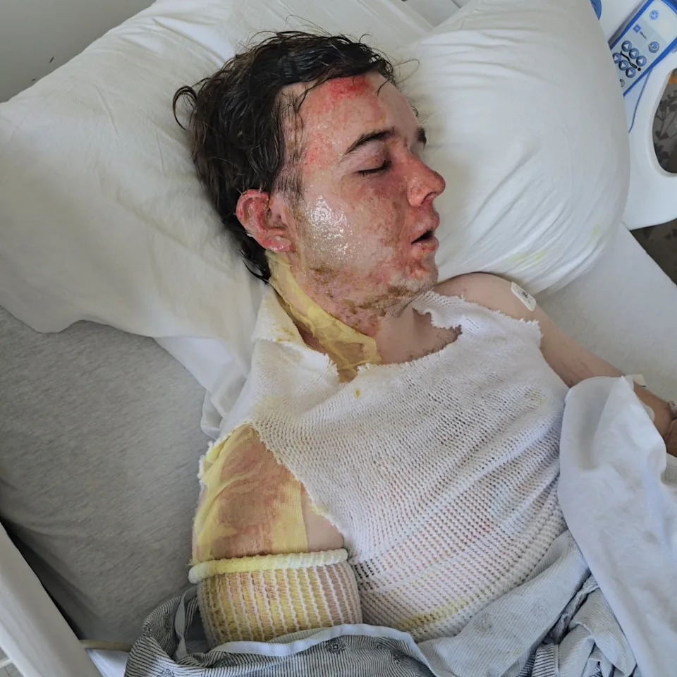 Jacob Smith suffered third-degree burns to his face, neck, hands and shoulders and<br>is receiving specialized treatment at UC Davis Medical Center. GoFundMe