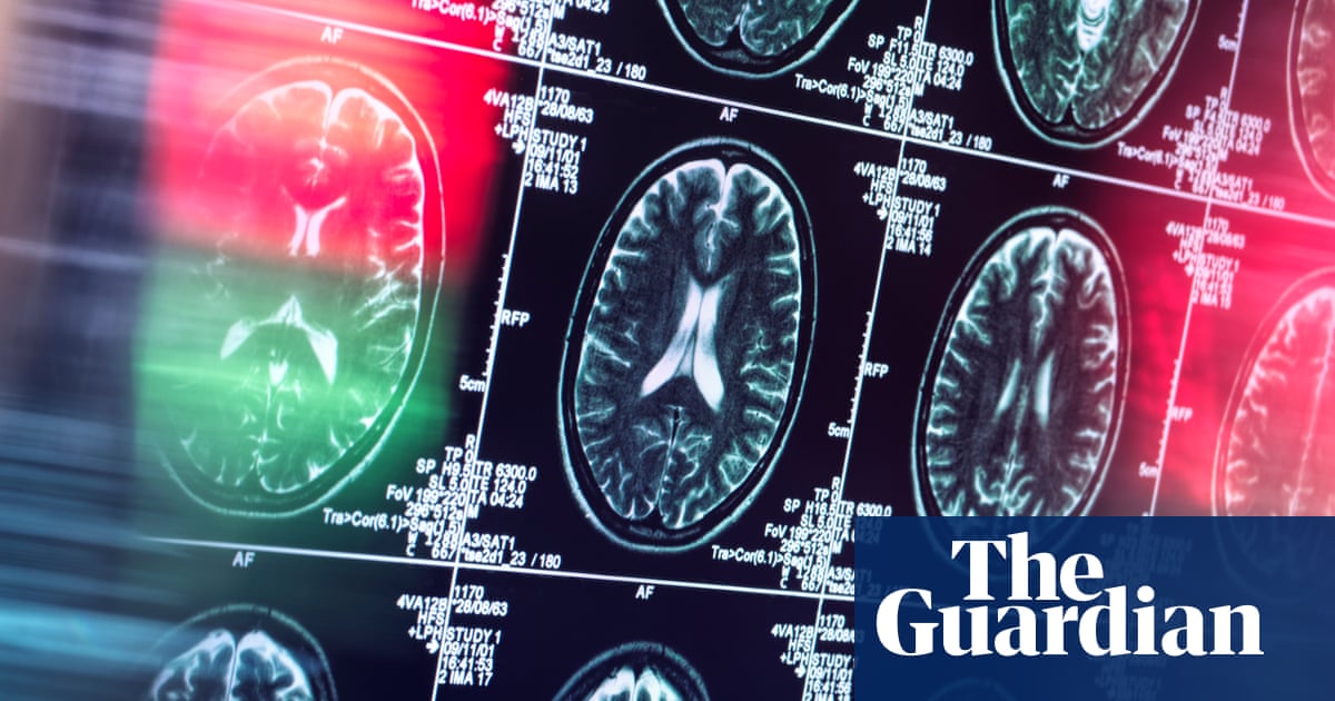 Antidepressants and antipsychotics could serve as alternatives to opioids, study finds | Opioids