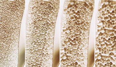 Bone Strength Osteoporosis Stages