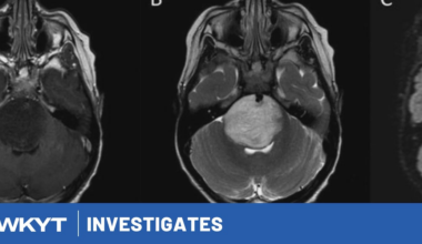 WKYT Investigates: Health officials confirm ‘unusual’ rise in rare pediatric brain tumor cases in Eastern Kentucky