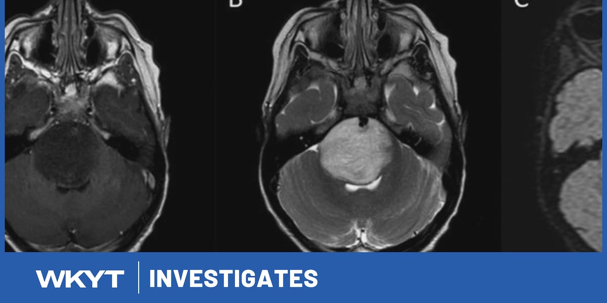 WKYT Investigates: Health officials confirm ‘unusual’ rise in rare pediatric brain tumor cases in Eastern Kentucky
