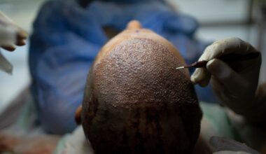 How Turkey Hacked the Hair-Transplant Industry