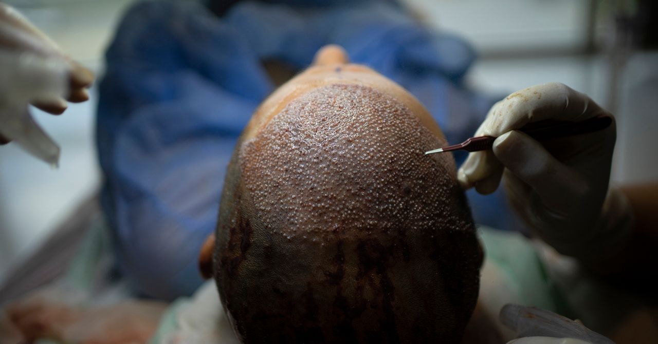 How Turkey Hacked the Hair-Transplant Industry
