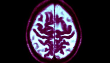 Dementia is rising, but your personal risk is falling