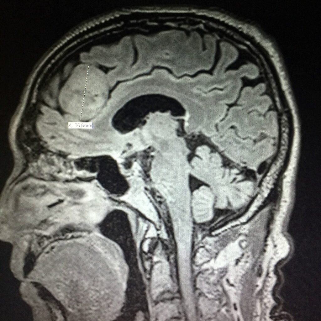 Newton-Wellesley Hospital's brain tumor investigation: New info on the 11 diagnosed nurses