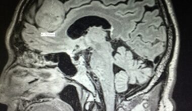 Newton-Wellesley Hospital's brain tumor investigation: New info on the 11 diagnosed nurses