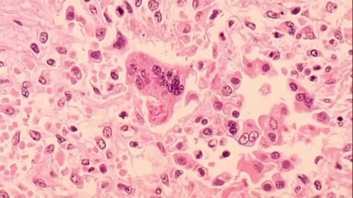 DPH confirms state’s second measles case, first in a vaccinated adult – NBC Connecticut