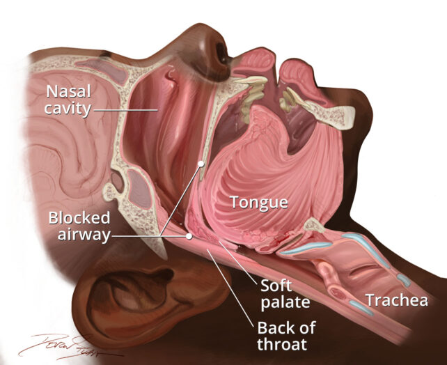 Illustration of obstructive sleep apnea showing a side view of the head and throat. The tongue and soft palate have fallen back toward the throat, blocking the airway between the nasal cavity and trachea.