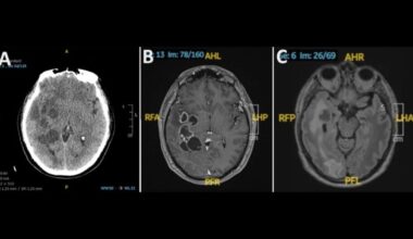Man's Suspected Brain Cancer Turns Out to Be Something Much Creepier