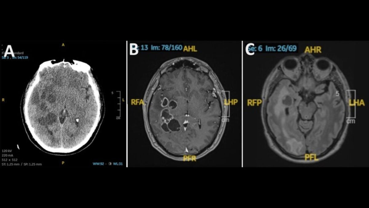 Man's Suspected Brain Cancer Turns Out to Be Something Much Creepier