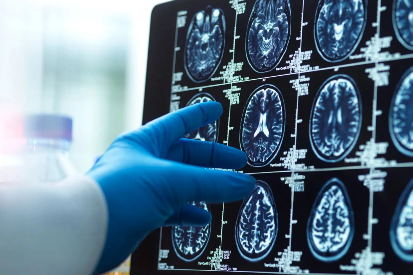 A brain scan image with a doctor's hand, representing medical diagnosis and research.