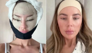 Woman Underwent Plastic Surgery in Turkey, Then Shared the Unfiltered Photos from Her 'No Pain' 15-Day Recovery