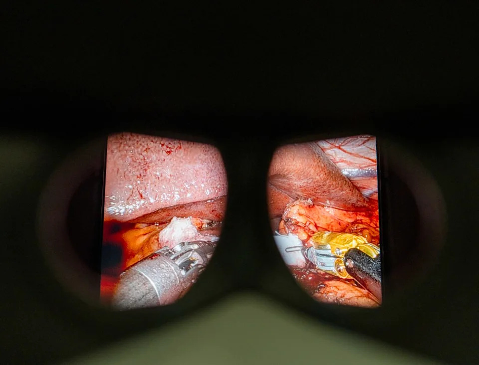 The view through a Da Vinci surgical robot. ZUMAPRESS.com