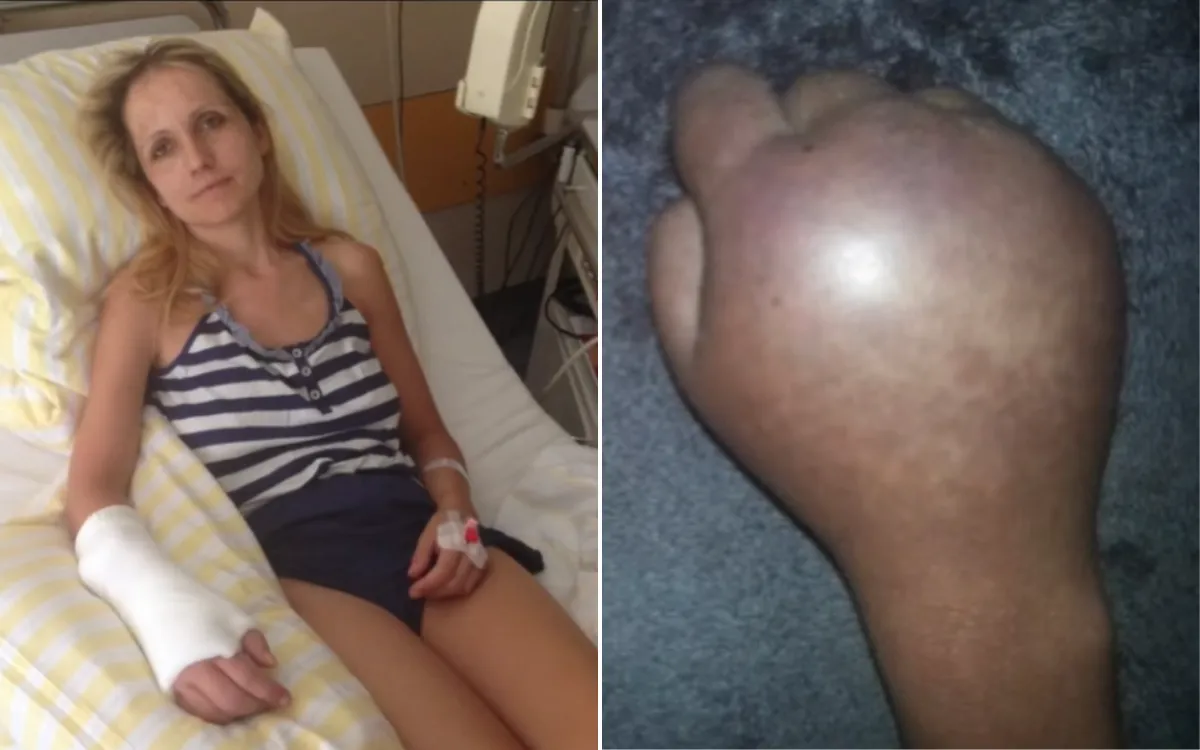 Wioletta Wyrwol and her swollen arm.