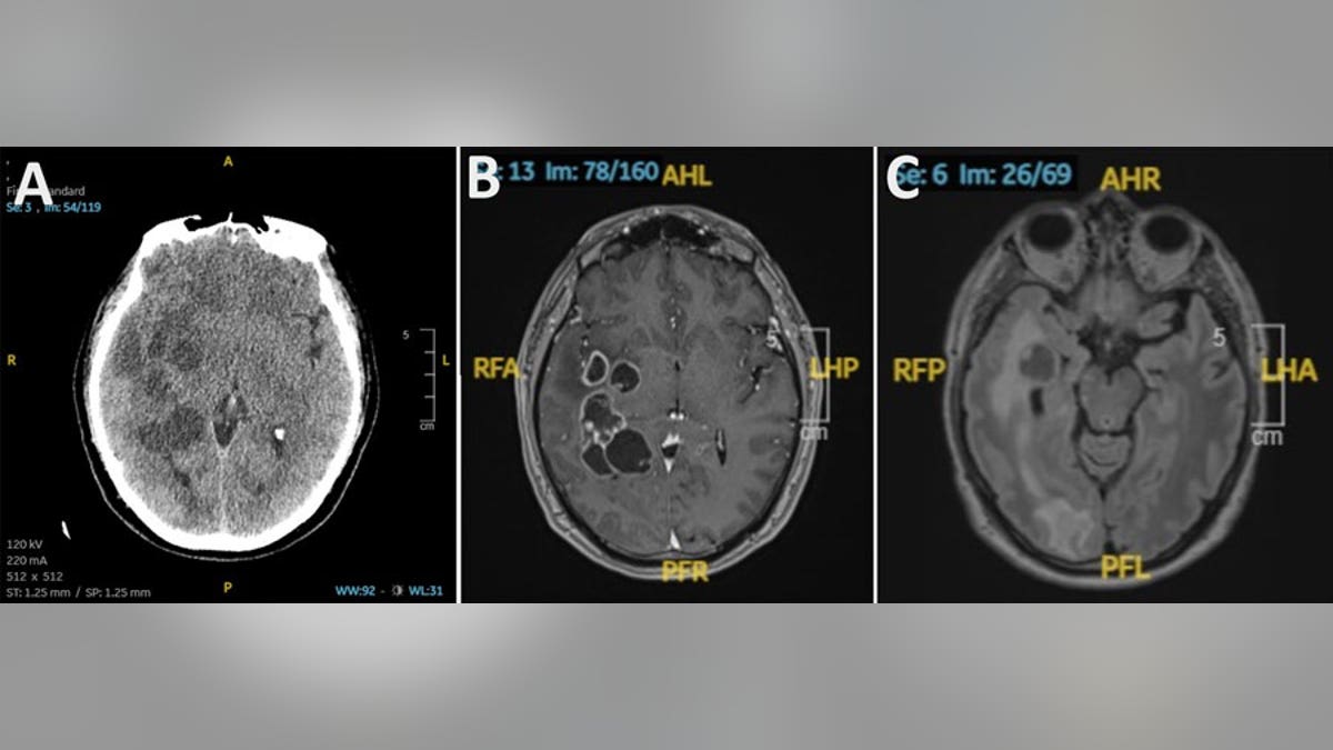 Brain scans showing tapeworm larvae