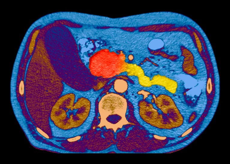A coloured CT scan through the abdomen of a patient showing the red, round mass of a cancerous tumour in the head of the pancreas