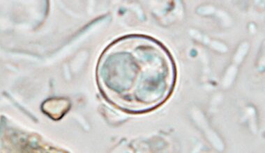 Parasite that causes ‘explosive diarrhea’ is spreading across the US