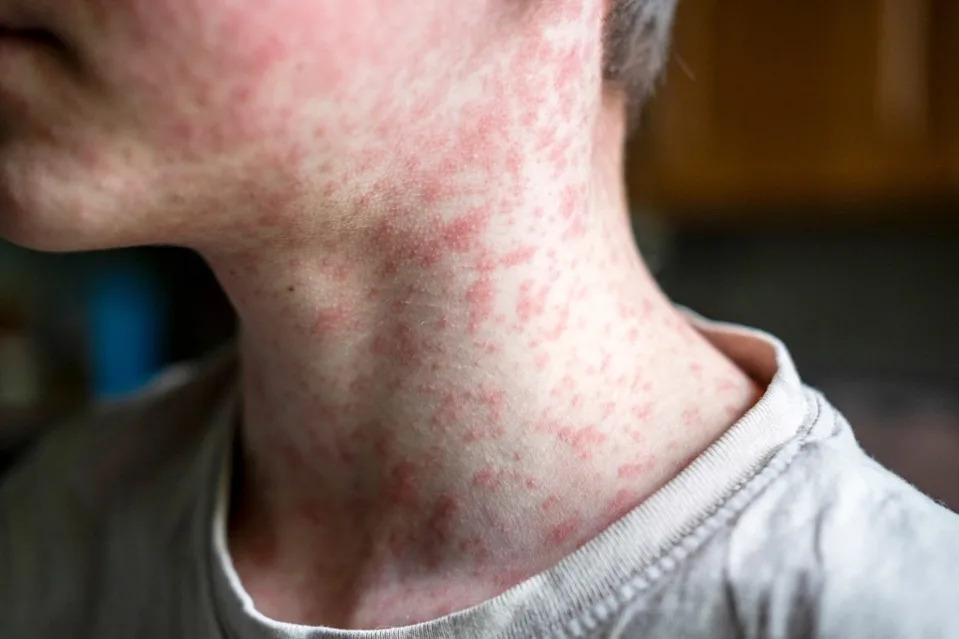 Scores of unsuspecting passengers may have been exposed to measles at Hollywood Burbank Airport. ÃÂðÃâðûÃÅàÃÅðùÃËõòð – stock.adobe.com