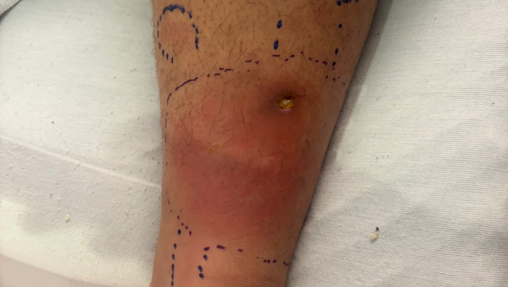 A leg with a red, inflamed area and a pustule, marked with blue pen.