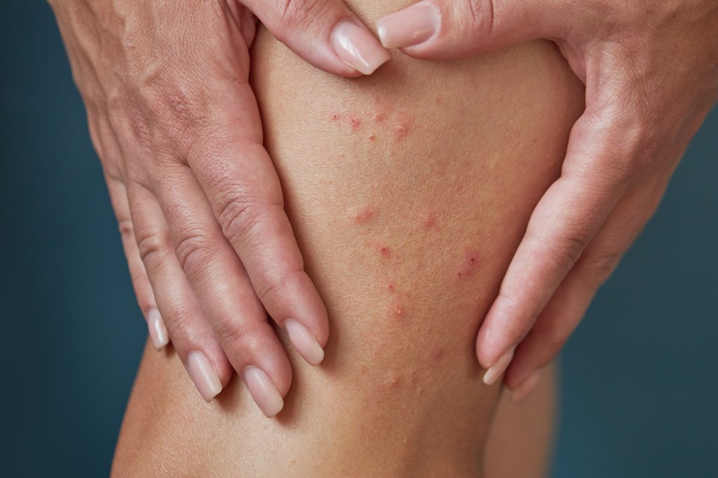 Woman's leg covered in red insect bite marks, her hands cupped around the affected area.