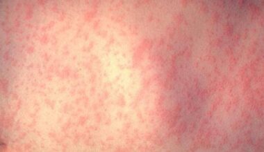 Measles case confirmed in Erie County